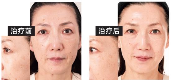白斑治疗效果，探索与理解