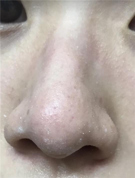 鼻子下面长痘的原因及其影响因素