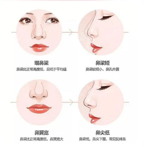 鼻子整形美容医院，专业塑造美丽与自信