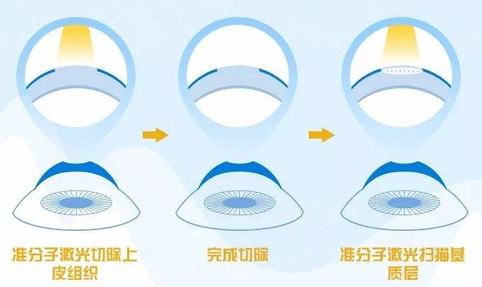 近视激光术后眼罩选择的重要性及其考量因素